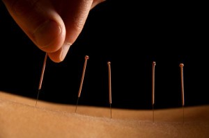 Acupuncture