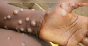 Nigeria's monkeypox cases hit 62
