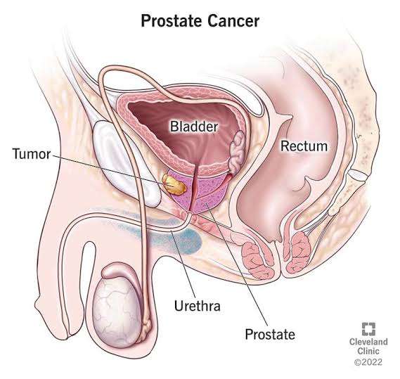 The prevalence of prostrate cancer, especially amongst older Nigerian men is an issue, which has been swept under the carpet for ages bordering on lack of awareness