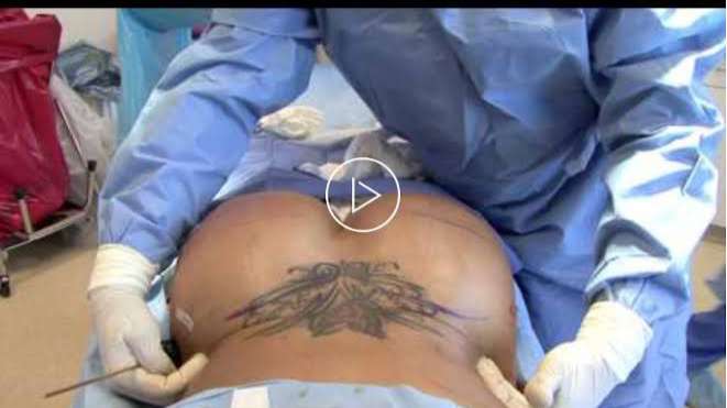 BBL, Liposuction pose health risks to Nigerian ladies, expert warns