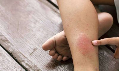 Experts, survivor raise awareness over life-threatening blood clot
