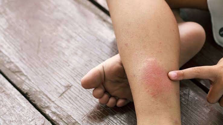 Experts, survivor raise awareness over life-threatening blood clot